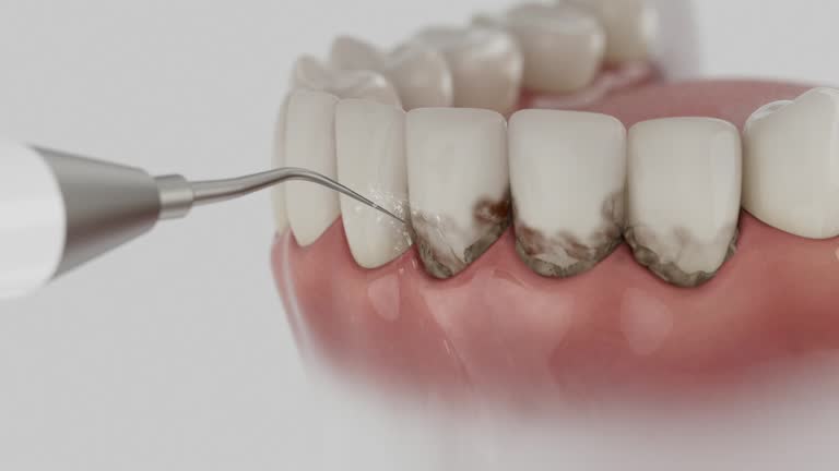 Reliable Dental Implants contractor in Iona, FL by Smile Center Dentistry